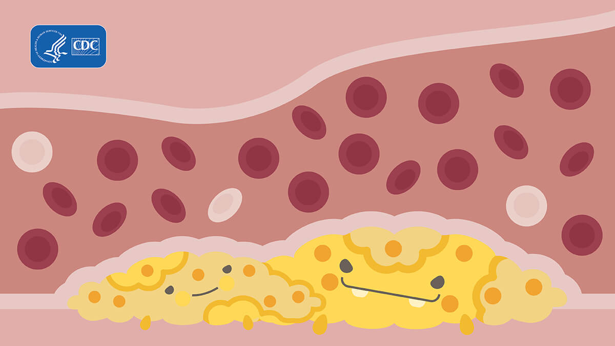 Illustration of yellow blob cholesterol monsters in arteries